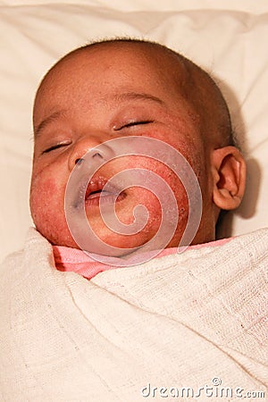 Baby with atopic dermatitis Stock Photo