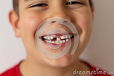 The baby boy smiling with wobbly milk tooth in open mouth. First molar teeth missing Stock Photo