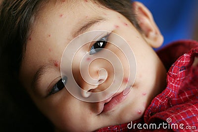 Baby with Chicken Pox Stock Photo