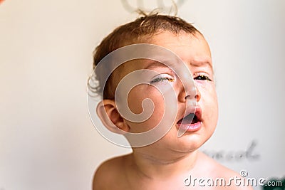 A baby with eyes full of rheum, produced by conjunctivitis, inflammation of the conjunctiva of bacterial origin Stock Photo