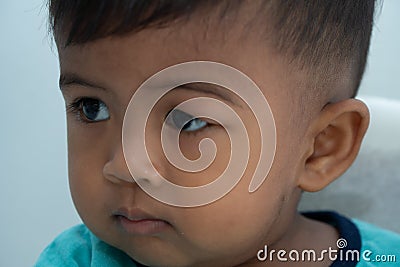 Baby has an allergic reaction to the eye, Urticaria in food allergy patien Stock Photo