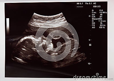 Baby head on ultrasound scan Stock Photo