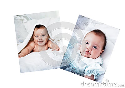 Baby Before and After Surgery Editorial Stock Photo