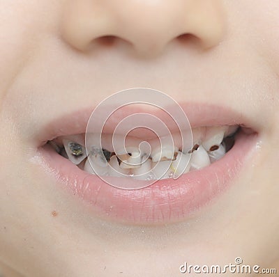 Baby teeth with caries Stock Photo