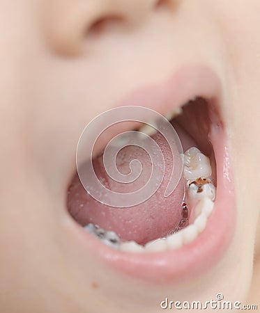 Baby teeth with caries Stock Photo