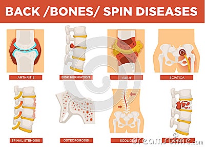 Back, bones and human spin diseases explanation vector Vector Illustration