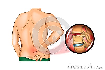 Back pain. damage to the spine Vector Illustration