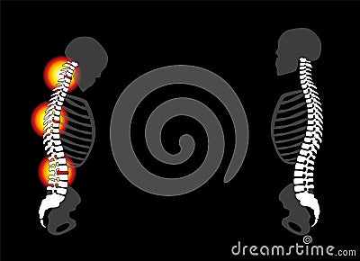 Back Problems Pain Slipped Disc Prolapse Healthy Back Vector Illustration