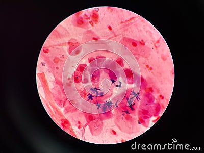 Bacteria cell in sputum sample Gram stain method Stock Photo