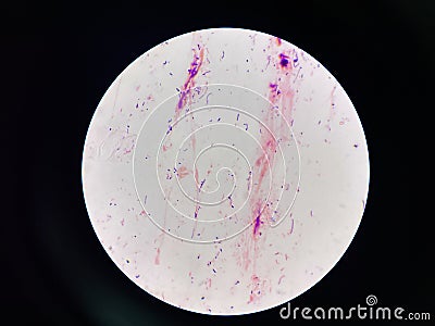Bacteria cell in sputum sample Gram stain method Stock Photo