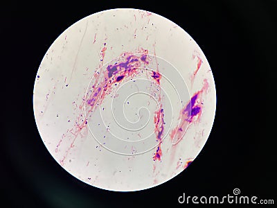 Bacteria cell in sputum sample Gram stain method Stock Photo