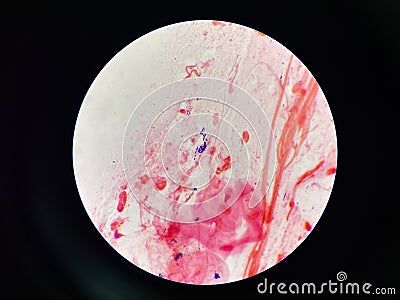 Bacteria cell in sputum sample Gram stain method Stock Photo