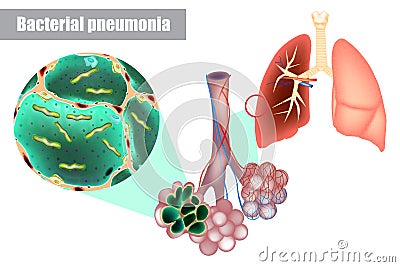 Bacteria inside alveoli of lung. Bacterial pneumonia bacterial infection. Vector Illustration