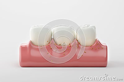 Bacterial collect on gums and tooth Stock Photo