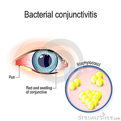 Bacterial conjunctivitis Vector Illustration