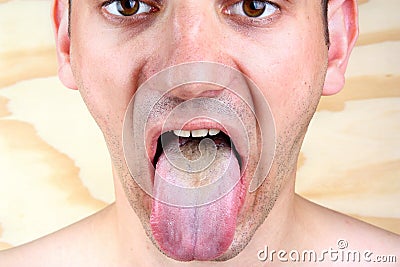 Bacterial infection disease tongue and herpes Stock Photo