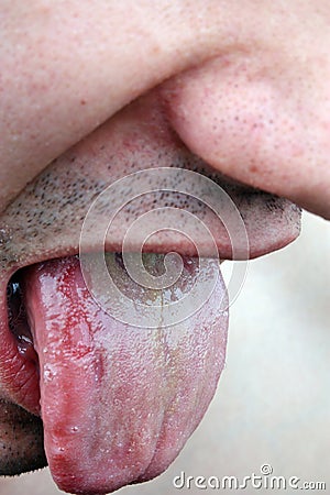 Bacterial infection disease tongue Stock Photo