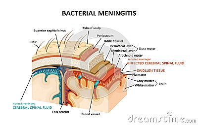 Bacterial meningitis Vector Illustration