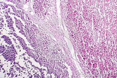 Bacterial myocarditis, inflammatory heart disease, histopathology Stock Photo