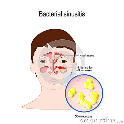 Bacterial sinusitis. Rhinitis Vector Illustration