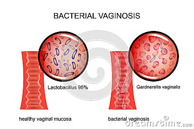 Bacterial vaginosis. the vagina and the causative agent Vector Illustration