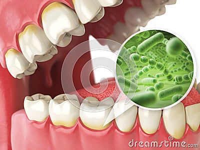 Bacterias and viruses around tooth. Dental hygiene medical concept. Cartoon Illustration