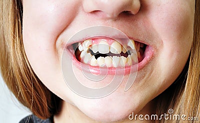 Bad teeth Stock Photo