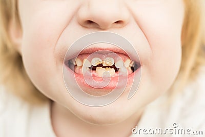 Bad teeth Stock Photo