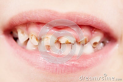 Bad teeth Stock Photo