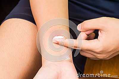 Baking soda being used to relieve itching from insect bites. Stock Photo