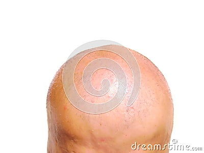 Bald head Stock Photo