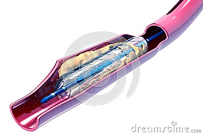 Balloon Expandable Stent Stock Photo