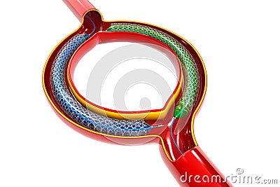 Balloon Expandable Stent Stock Photo