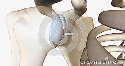 A Bankart lesion occurs as the result of a forward shoulder dislocation Stock Photo