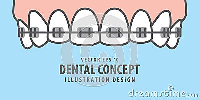 Banner Upper Braces teeth illustration vector on blue background Vector Illustration