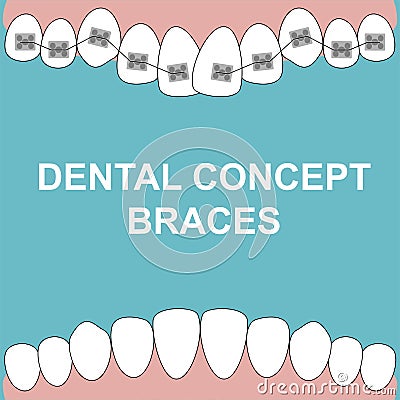 Banner Upper Braces teeth illustration vector on blue background. Dental concept Vector Illustration