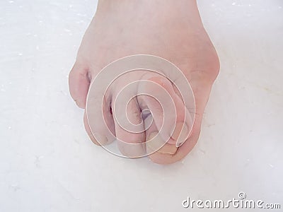 Bare foots which have Hallux Valgus problem. Stock Photo