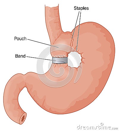 Bariatric surgery Vector Illustration