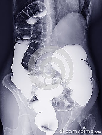 Barium enema or BE is image of large bowel . Stock Photo
