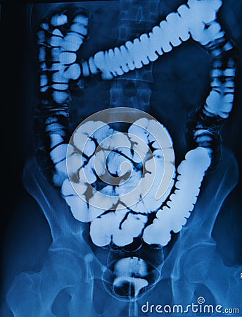 Barium enema of a man Stock Photo