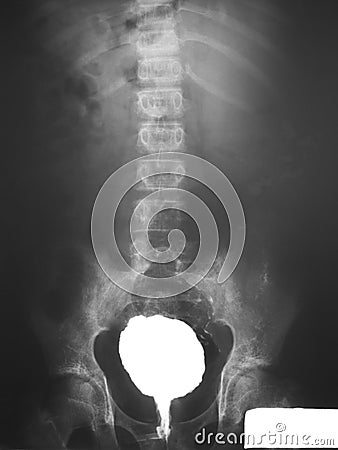 Barium enema of a patient, demonstrated obstruction of contrast media at rectal region and irregular rectal mucosa. Stock Photo