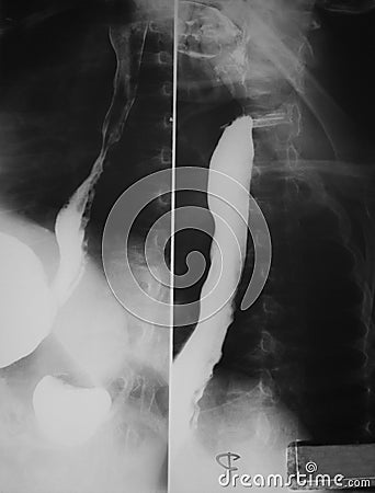 Barium swallowing study of a 21 years old woman, demonstrated normal esophagus both antero-posterior and lateral views. Stock Photo