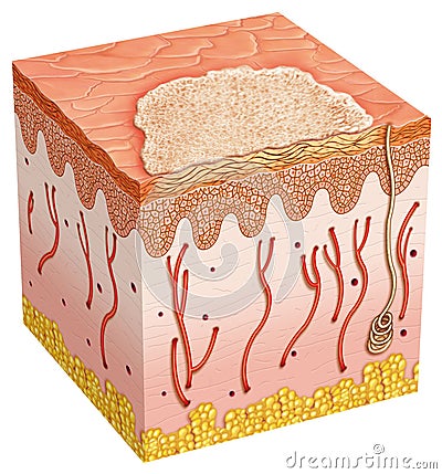 Basal cell carcinoma Stock Photo