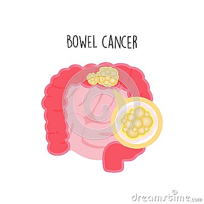 Bowel Cancer flat illustration. Cartoon Illustration
