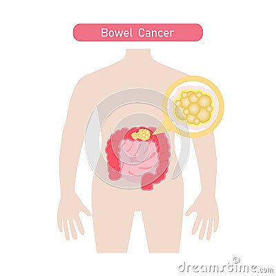 Bowel Cancer flat illustration. Cartoon Illustration