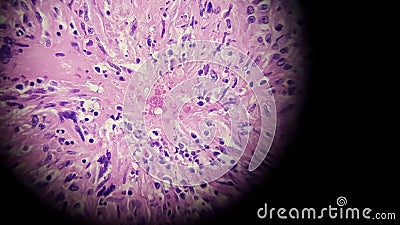 Basidiobolus fungal hyphae in colon biopsy specimen Stock Photo