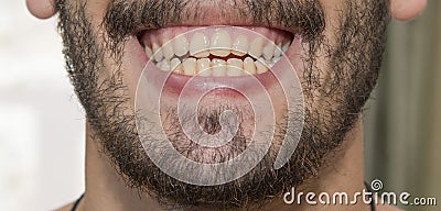 The bearded man smiles, showing bad teeth. Stock Photo