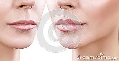 Lips of adult woman before and after augmentation Stock Photo