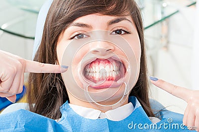 Beautiful patient face wearing mouth retractor in dentistry office Stock Photo