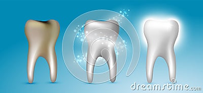 Beautiful realistic dentist vector set of teeth cleansing process with decayed, cleansed and white shiny teeth on blue background Vector Illustration